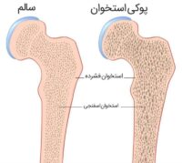 پوکی استخوان معروف به بیماری خاموش است