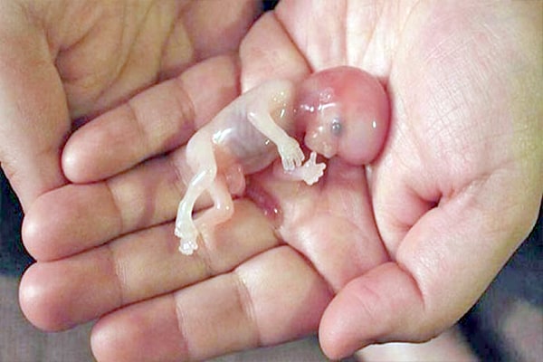 علل، انواع و عوارض سقط جنین